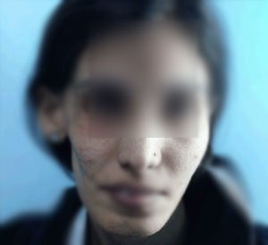 Asymmetrical Face Treatment Asymmetrical Face Treatment in Hyderabad