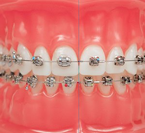 braces in hyderabad