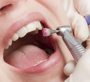 Teeth Cleaning