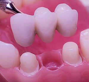 Dental Bridge