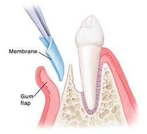 Flap Surgeries in Hyderabad