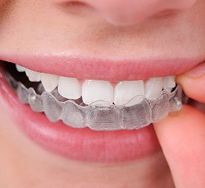 invisalign in hyderabad