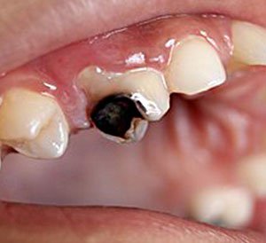 Tooth Decay Treatment