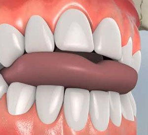 Open Bite Correction Open Bite Correction in Hyderabad
