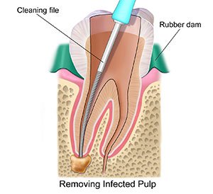 root canal