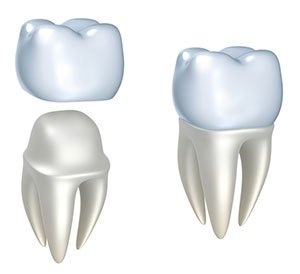 dental crown hyderabad