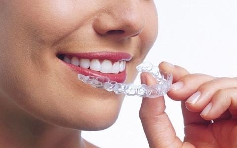 Invisalign vs Braces