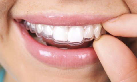 What is Invisalign