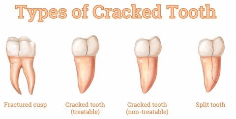 Types of Cracked Tooth 