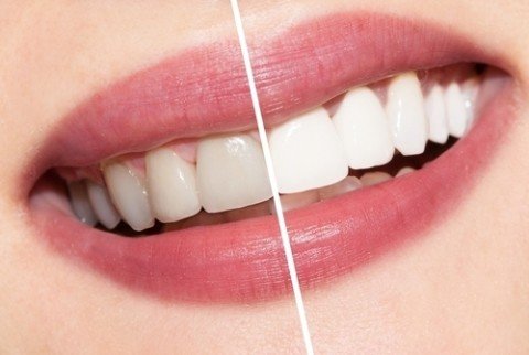 Teeth Bleaching