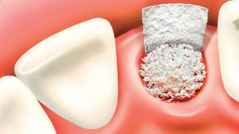 Bone Graft For Dental Implants