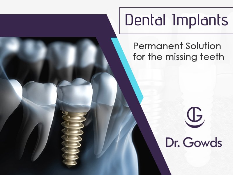 Different Types Of Dental Implants